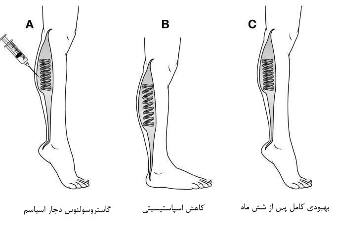جراحی تاندون آشیل
