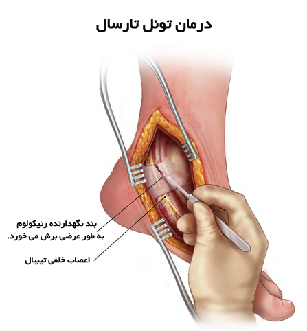 جراحی تونل تارسال