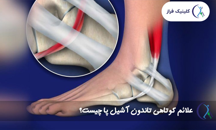 علائم کوتاهی تاندون آشیل پا چیست؟