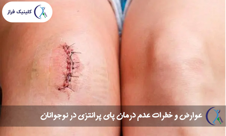 عوارض و خطرات عدم درمان پای پرانتزی در نوجوانان