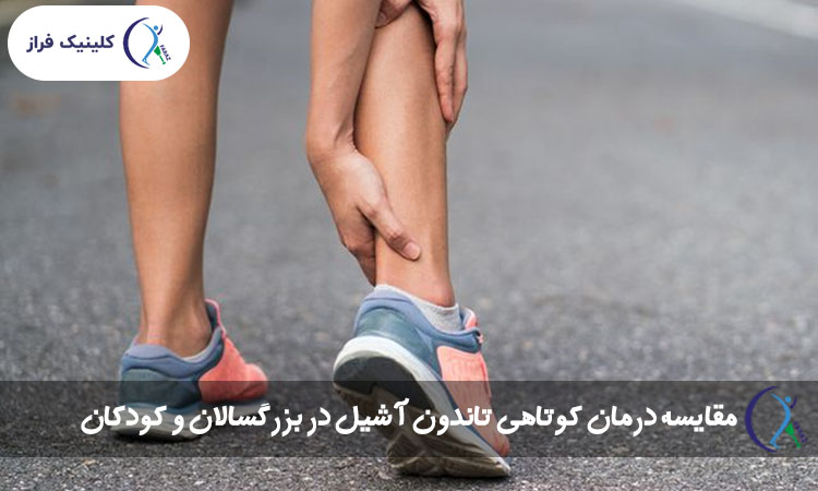 مقایسه درمان کوتاهی تاندون آشیل در بزرگسالان و کودکان