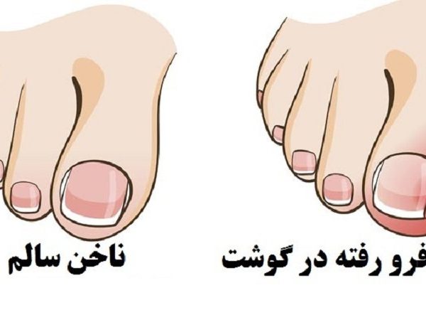 فرو رفتن ناخن در گوشت