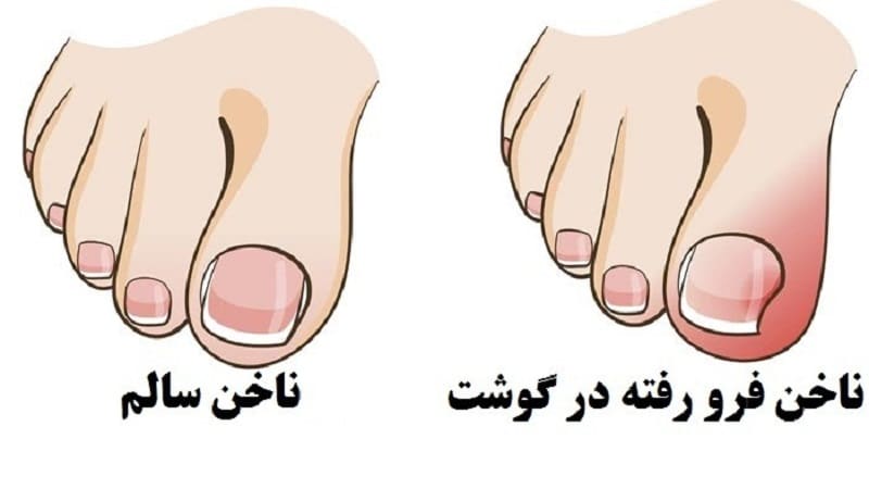 فرو رفتن ناخن در گوشت