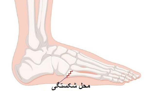 شکستگی کف پا