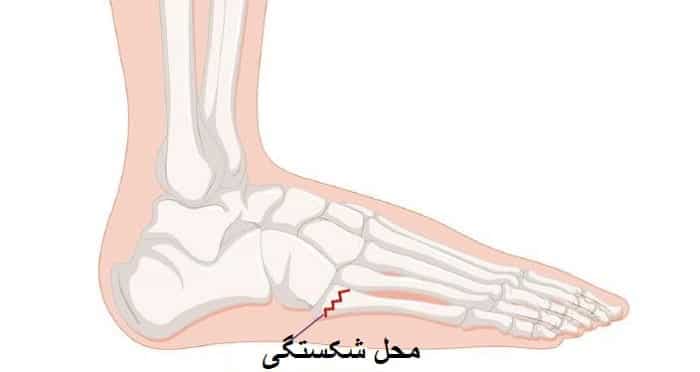 شکستگی کف پا