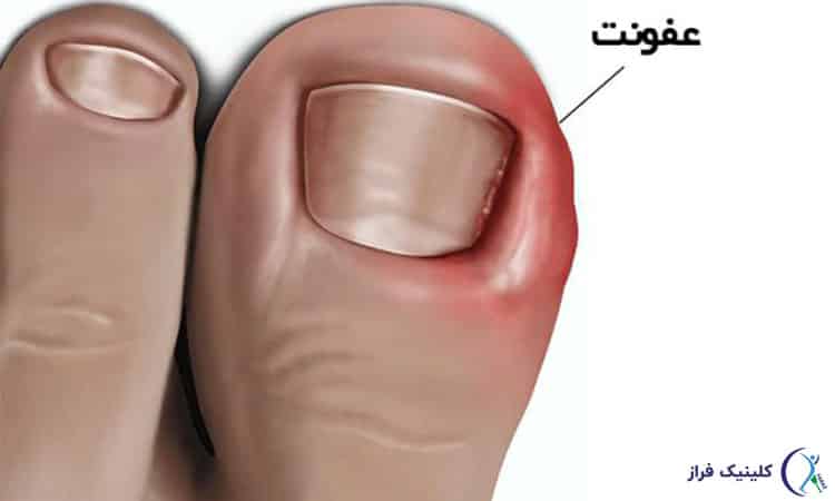 عفونت شست پا