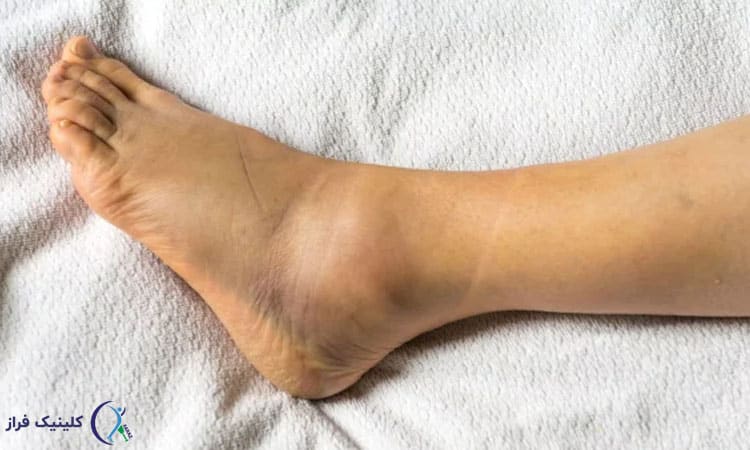 علائم پیچ خوردگی مچ پا