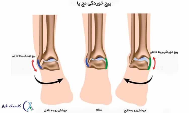 پیچ ​​خوردگی مچ پا