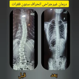عکس درمان غیر جراحی اسکولیوز در کلینیک فراز