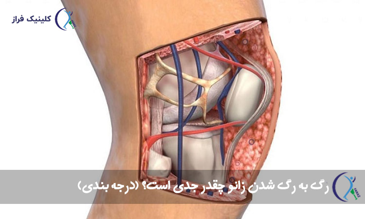 رگ به رگ شدن زانو چقدر جدی است؟ (درجه بندی)