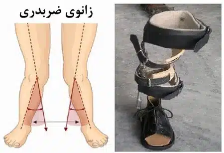 بریس زانو ضربدری