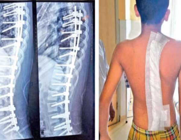 مراقبت های بعد از جراحی اسکولیوز