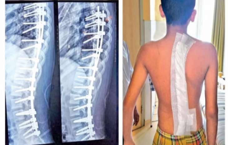 مراقبت های بعد از جراحی اسکولیوز