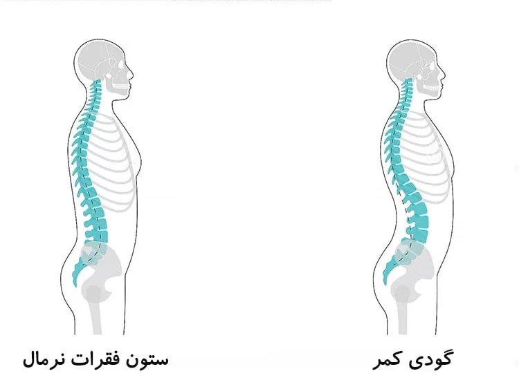 گودی کمر چیست
