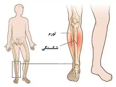 مراقبت بعد از شکستگی ساق پا