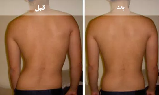 بهبودی بعد از جراحی اسکولیوز