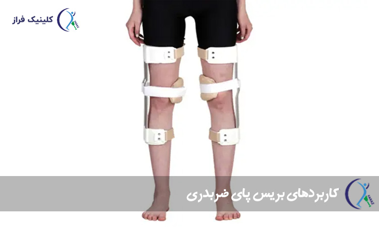 کاربردهای بریس پای ضربدری