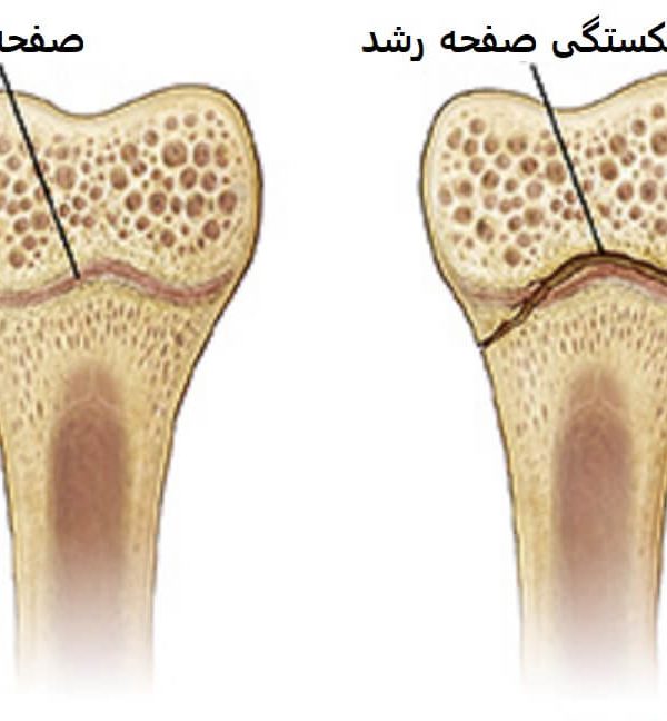 علائم شکستگی صفحه رشد
