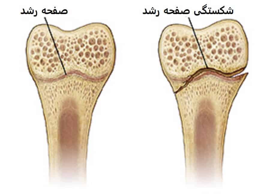 علائم شکستگی صفحه رشد
