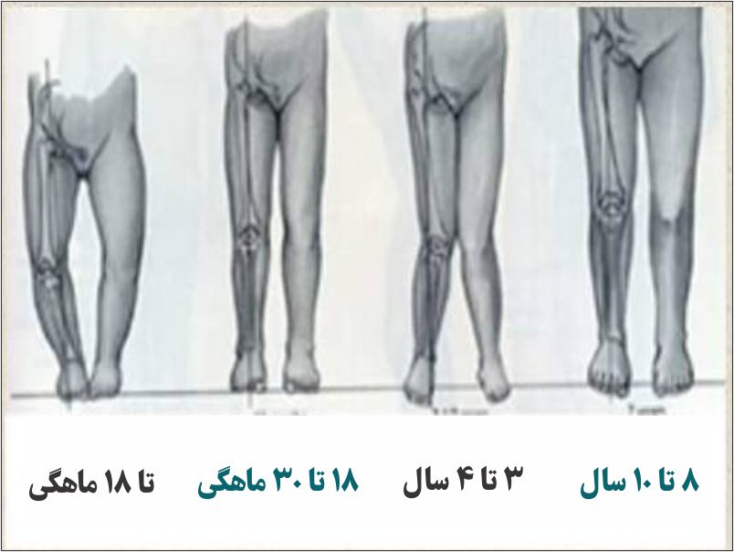 انحراف زانو در کودکان در سنین مختلف
