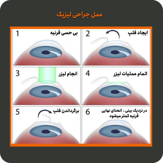 مراحل عمل لیزیک چشم