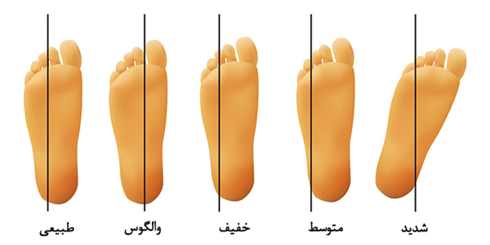 تشخیص انحراف پای نوزاد