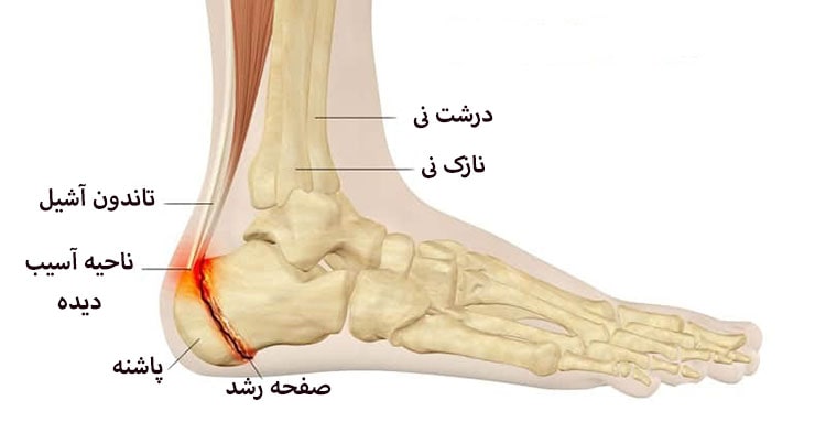 انواع شکستگی صفحه رشد