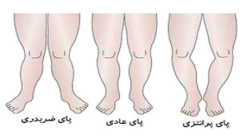 شکل طبیعی پای کودکان