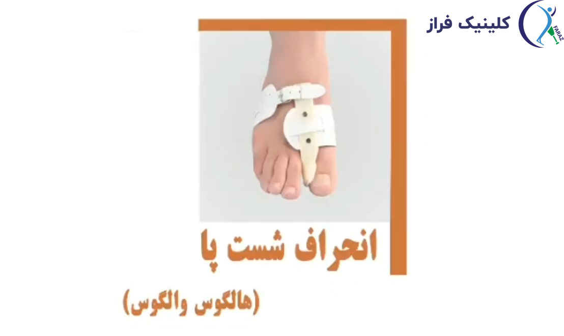 انحراف شست پا