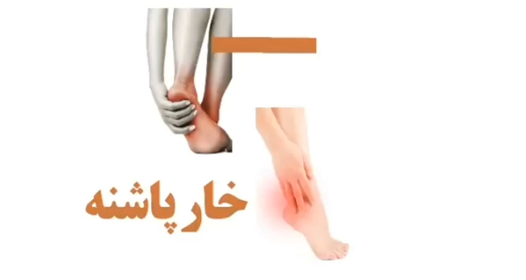 درمان خارپاشنه