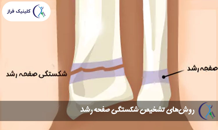 روش‌های تشخیص شکستگی صفحه رشد