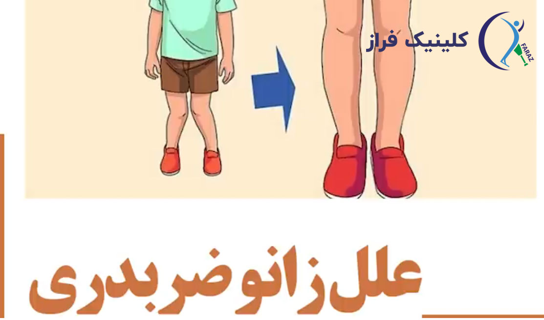 علل زانو ضربدری