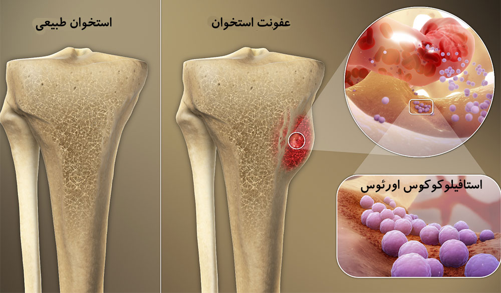 عفونت مفاصل و استخوان ها