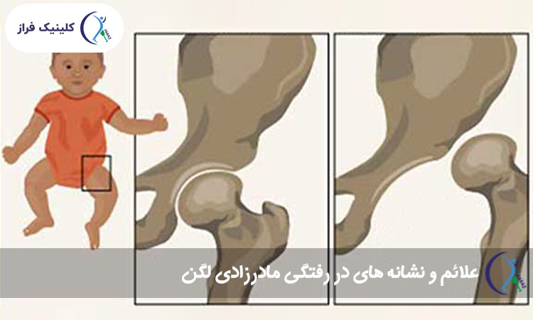 علائم و نشانه های در رفتگی مادرزادی لگن
