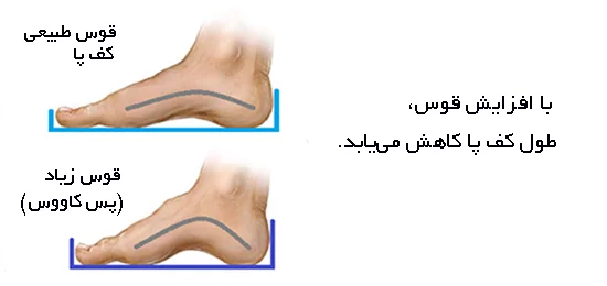پای کاووس در کودکان