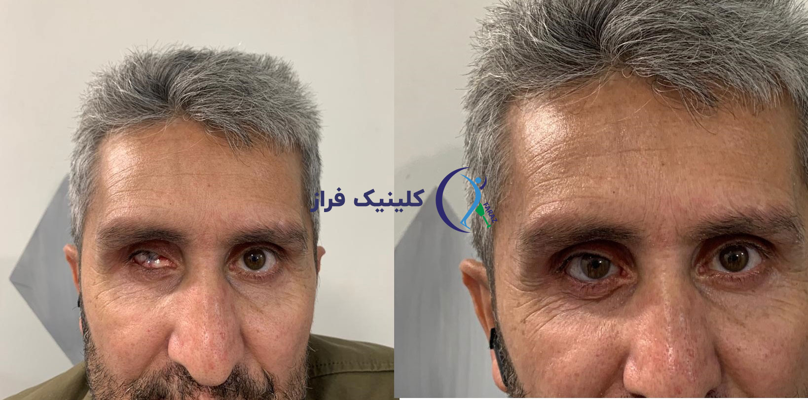 رضایت بیمار از پروتز چشم در کلینیک فراز