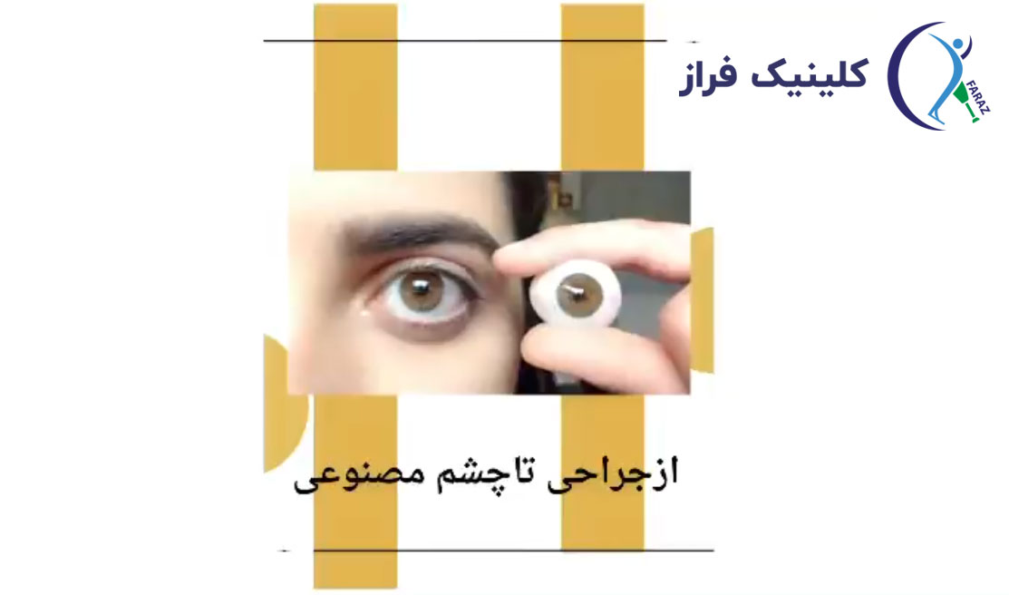 پروتز چشم چیست