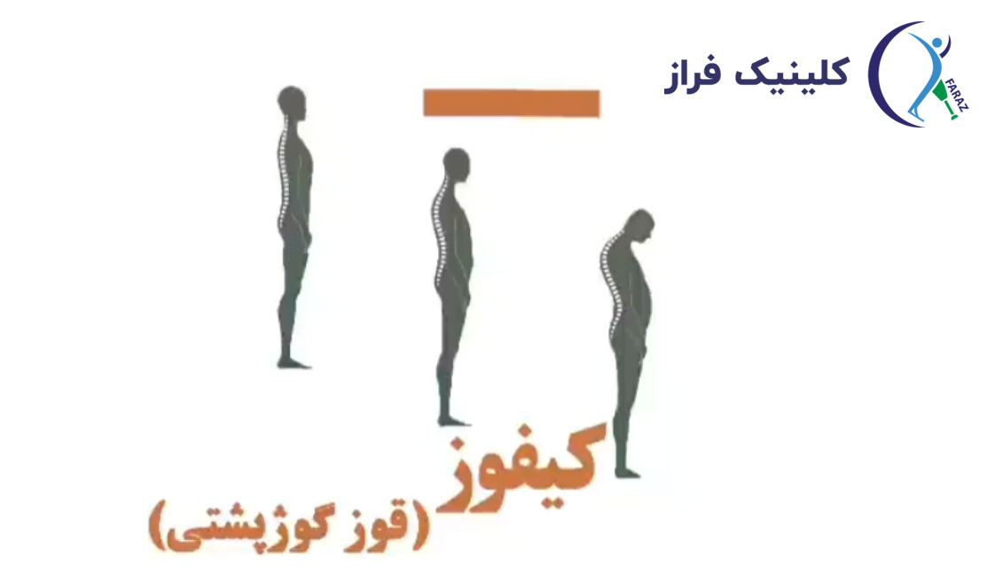 درمان کیفوز
