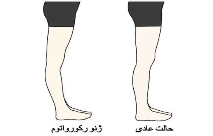 عکس عقب زدگی زانو