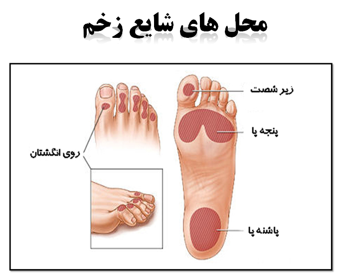 زخم پای دیابتی