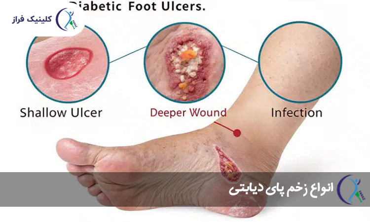 انواع زخم پای دیابتی