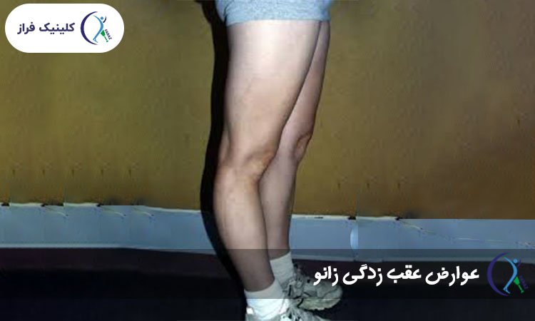 عوارض عقب زدگی زانو