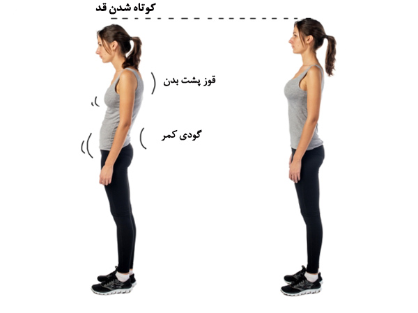 عوارض قوز کمر یا کیفوز