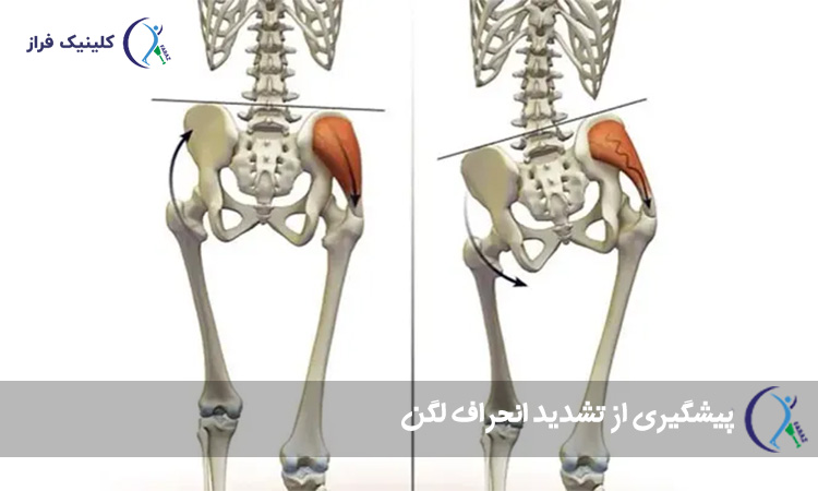 پیشگیری از تشدید انحراف لگن