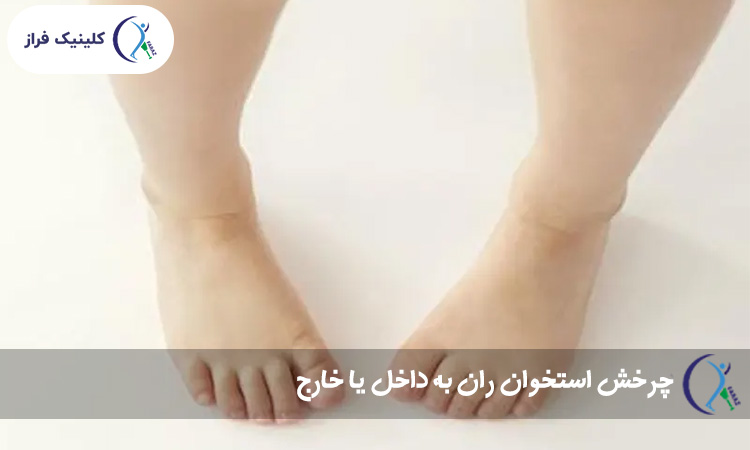 چرخش استخوان ران به داخل یا خارج