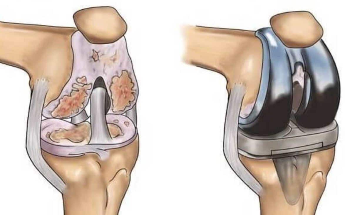 تعویض مفصل زانو