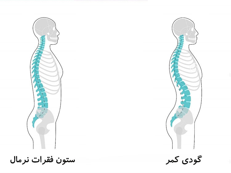 تشخیص گودی کمر