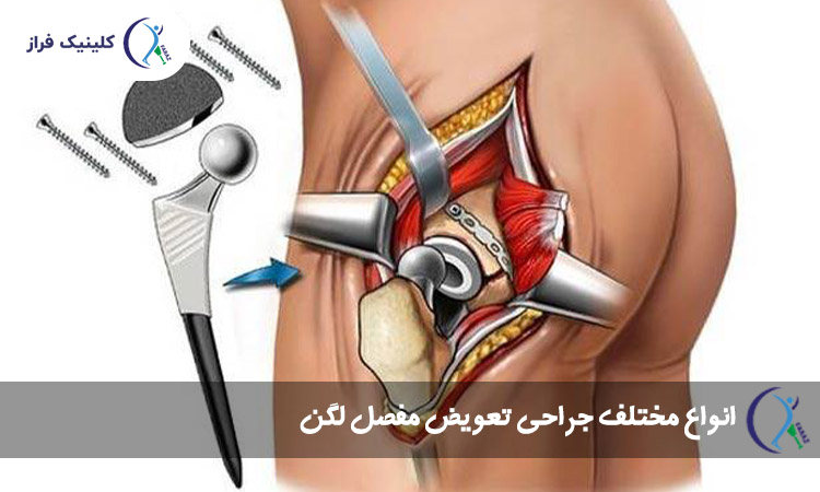 انواع مختلف جراحی تعویض مفصل لگن