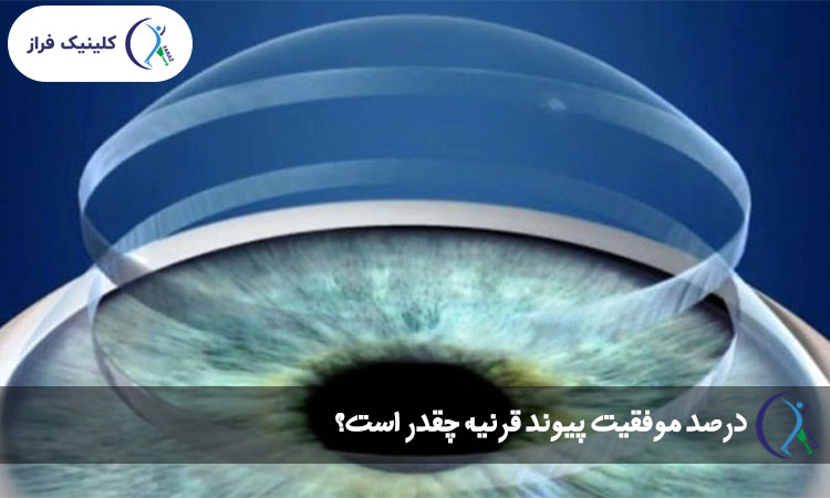 درصد موفقیت پیوند قرنیه چقدر است؟