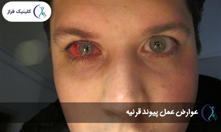 عوارض عمل پیوند قرنیه
